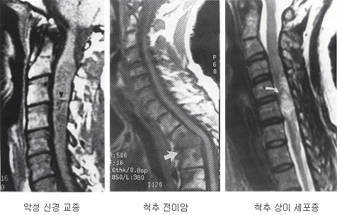 악성 신경 교종 / 척추 전이암 / 척추 상이 세포종