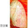 정상폐
