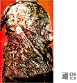 폐암