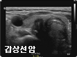 갑상선암