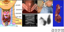 갑상선암 및 기타질환