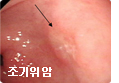 초기위암