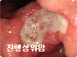 진행성위암