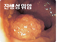 진행성위암