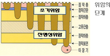 위암의 단계 : 