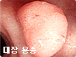 초기위암