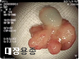 대장용종
