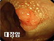 대장암