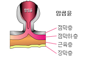암첨윤-점막층,점막하층,근육층,장막층